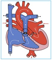 点線部分が狭窄した肺動脈